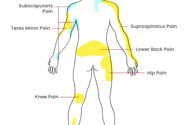 Trigger points of the body Worksheet